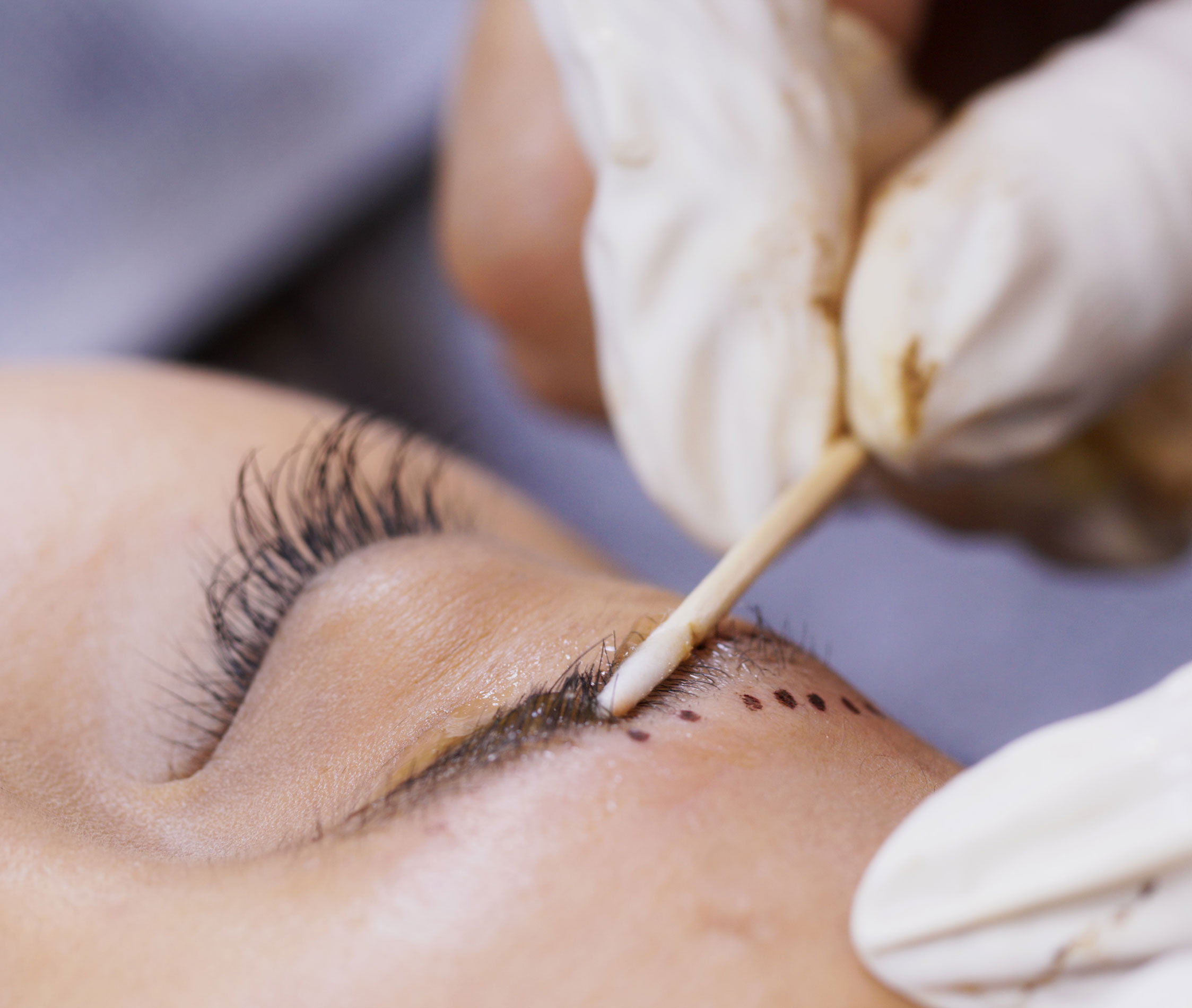 Βλεφαροπλαστική